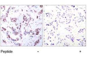 Immunohistochemical analysis of paraffin-embedded human breast carcinoma tissue using MEF2A polyclonal antibody  . (MEF2A Antikörper)