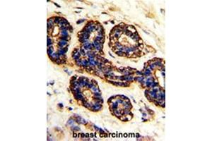 Formalin-fixed and paraffin-embedded human breast carcinoma with BEST2 Antibody (C-term), which was peroxidase-conjugated to the secondary antibody, followed by DAB staining. (Bestrophin 2 Antikörper  (C-Term))