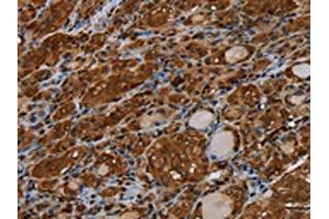 The image on the left is immunohistochemistry of paraffin-embedded Human thyroid cancer tissue using ABIN7191558(MYBBP1A Antibody) at dilution 1/40, on the right is treated with synthetic peptide.