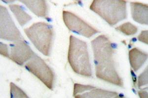Immunohistochemistry (IHC) analyzes of 14-3-3 ζ (pVal52) antibody in paraffin-embedded human breast carcinoma tissue. (14-3-3 zeta Antikörper)