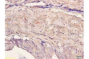 Formalin-fixed and paraffin embedded human colon carcinoma with Anti-Pokemon Polyclonal Antibody, Unconjugated (ABIN729448) at 1:200, followed by conjugation to the secondary antibody and DAB staining (ZBTB7A Antikörper  (AA 151-250))