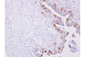 IHC-P Image POR antibody detects POR protein at cytoplasm on human ovarian carcinoma by immunohistochemical analysis. (POR Antikörper  (N-Term))