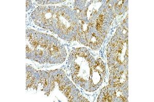 Immunohistochemistry of paraffin-embedded human colon carcinoma using MRPS15 Rabbit mAb (ABIN7268582) at dilution of 1:250 (40x lens). (MRPS15 Antikörper)