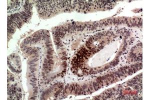 Immunohistochemistry (IHC) analysis of paraffin-embedded Human Colon Cancer, antibody was diluted at 1:100. (Histone H2A Antikörper  (Internal Region))