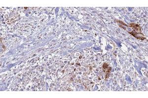 ABIN6277697 at 1/100 staining Human urothelial cancer tissue by IHC-P. (Integrin Alpha2b Antikörper  (Internal Region))