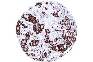 Muscle invasive urothelial carcinoma of the urinary bladder showing strong HMGB1 positivity of all tumor cells.