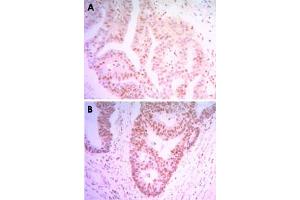 Immunohistochemical analysis of paraffin-embedded human colon cancer tissue (A) and ovary cancer tissue (B) using THAP11 monoclonal antobody, clone 3F3  with DAB staining.