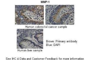 Immunohistochemistry (IHC) image for anti-Matrix Metallopeptidase 1 (Interstitial Collagenase) (MMP1) (N-Term) antibody (ABIN2777119)