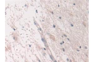 Detection of USP6NL in Human Glioma Tissue using Polyclonal Antibody to USP6 N-Terminal Like Protein (USP6NL)