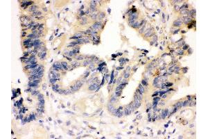 Anti-Caspase-7(P11) antibody, IHC(P) IHC(P): Human Intestinal Cancer Tissue (Caspase 7 Antikörper  (Middle Region))
