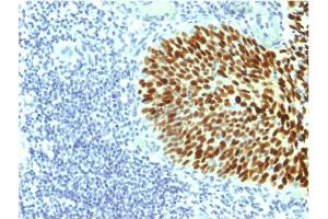 Formalin-fixed, paraffin-embedded human Cervical Carcinoma stained with SOX2 Mouse Monoclonal Antibody (SOX2/1791). (SOX2 Antikörper  (AA 176-305))