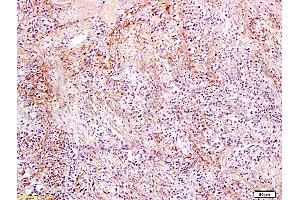 Formalin-fixed and paraffin embedded rat colon carcinoma labeled with Anti-Slc22A17 Y Polyclonal Antibody, Unconjugated (ABIN668691) at 1:300, followed by conjugation to the secondary antibody and DAB staining (SLC22A17 Antikörper  (AA 475-538))