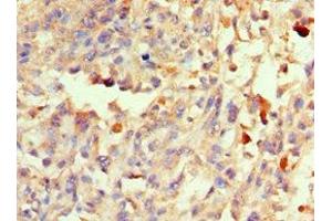 Immunohistochemistry of paraffin-embedded human melanoma using ABIN7166082 at dilution of 1:100 (40S Ribosomal Protein S3-B (RPS3.S) (AA 1-92) Antikörper)