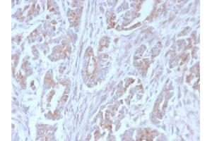 Formalin-fixed, paraffin-embedded human Colon Carcinoma stained with ICOS-L Mouse Monoclonal Antibody (ICOSL/3111). (ICOSLG Antikörper  (AA 23-149))
