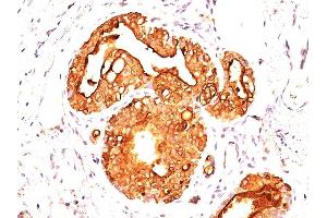 Formalin-fixed, paraffin-embedded human Breast Carcinoma stained with MUC-1 / CA15-3 / EMA Mouse Monoclonal Antibody (MUC1/955). (MUC1 Antikörper)