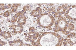 ABIN6272771 at 1/100 staining Human liver cancer tissue by IHC-P. (OR4N2 Antikörper)