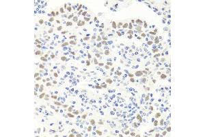 Immunohistochemistry of paraffin-embedded human esophageal cancer using EXO1 antibody (ABIN6129824, ABIN6140356, ABIN6140357 and ABIN6219087) at dilution of 1:100 (40x lens). (Exonuclease 1 Antikörper  (AA 601-846))