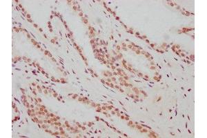 IHC image of ABIN7127344 diluted at 1:183 and staining in paraffin-embedded human prostate cancer performed on a Leica BondTM system. (Rekombinanter ARNT Antikörper)
