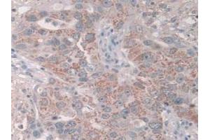 IHC-P analysis of Human Breast Cancer Tissue, with DAB staining. (GRB10 Antikörper  (AA 392-594))