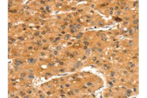 The image on the left is immunohistochemistry of paraffin-embedded Human liver cancer tissue using ABIN7192437(SLC24A4 Antibody) at dilution 1/35, on the right is treated with synthetic peptide. (SLC24A4 Antikörper)