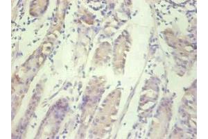 Immunohistochemical of paraffin-embedded human gastric cancer tissue using ABIN7156932 at dilution of 1:200. (IL-8 Antikörper)