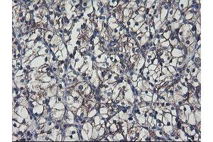 Immunohistochemical staining of paraffin-embedded Carcinoma of Human kidney tissue using anti-SH2D2A mouse monoclonal antibody. (SH2D2A Antikörper)