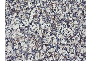 Immunohistochemical staining of paraffin-embedded Carcinoma of Human kidney tissue using anti-SH2D2A mouse monoclonal antibody. (SH2D2A Antikörper)
