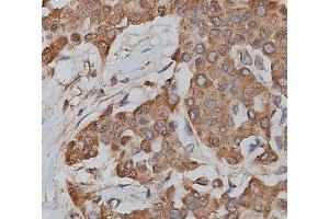 ABIN6279217 at 1/200 staining human lymphoma tissue sections by IHC-P. (slc25a13 Antikörper  (C-Term))