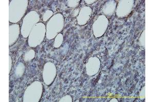 Immunoperoxidase of monoclonal antibody to RAP2B on formalin-fixed paraffin-embedded human malignant lymphoma, diffuse large B tissue. (RAP2B Antikörper  (AA 1-183))