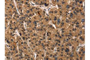 The image on the left is immunohistochemistry of paraffin-embedded Human liver cancer tissue using ABIN7190461(DEFA5 Antibody) at dilution 1/15, on the right is treated with synthetic peptide. (DEFA5 Antikörper)