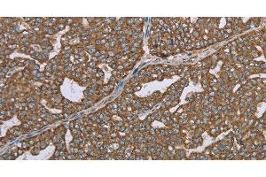 Immunohistochemistry of paraffin-embedded Human ovarian cancer using CERS4 Polyclonal Antibody at dilution of 1:35 (LASS4 Antikörper)