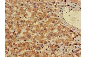 Immunohistochemistry of paraffin-embedded human liver cancer using ABIN7155691 at dilution of 1:100 (EN2 Antikörper  (AA 1-251))