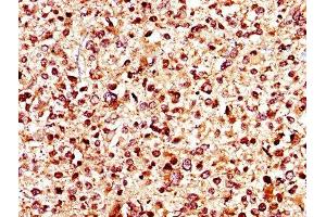 IHC image of ABIN7145017 diluted at 1:400 and staining in paraffin-embedded human glioma performed on a Leica BondTM system. (KCNJ1 Antikörper  (AA 165-379))