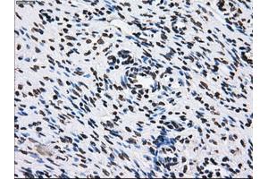 Immunohistochemical staining of paraffin-embedded Adenocarcinoma of breast tissue using anti-ID3 mouse monoclonal antibody. (ID3 Antikörper)