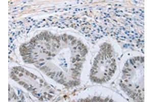 The image on the left is immunohistochemistry of paraffin-embedded Human colon cancer tissue using ABIN7191633(NEUROG2 Antibody) at dilution 1/15, on the right is treated with synthetic peptide. (Neurogenin 2 Antikörper)