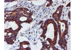 Immunohistochemical staining of paraffin-embedded Adenocarcinoma of Human colon tissue using anti-MEF2C mouse monoclonal antibody. (MEF2C Antikörper)