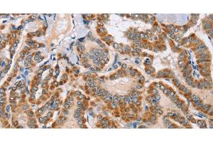 Immunohistochemistry of paraffin-embedded Human thyroid cancer using MSMB Polyclonal Antibody at dilution of 1:30 (MSMB Antikörper)