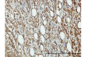 Immunoperoxidase of monoclonal antibody to EIF5 on formalin-fixed paraffin-embedded human malignant lymphoma, diffuse large B tissue. (EIF5 Antikörper  (AA 1-431))