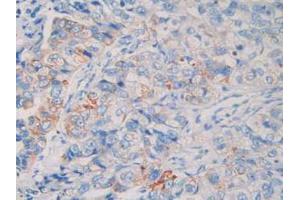 IHC-P analysis of Human Breast Cancer Tissue, with DAB staining. (MME Antikörper  (AA 382-538))