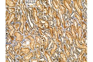 ABIN6257628 and ABIN6274171 at 1/100 staining Human kidney cancer and adjacent normal tissues by IHC-P.