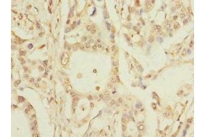 Immunohistochemistry of paraffin-embedded human pancreatic cancer using ABIN7163816 at dilution of 1:100 (PKD2L2 Antikörper  (AA 390-523))
