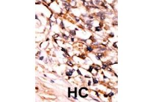 Formalin-fixed and paraffin-embedded human hepatocellular carcinoma tissue reacted with MAPKAPK5 (phospho S93) polyclonal antibody  which was peroxidase-conjugated to the secondary antibody followed by DAB staining.