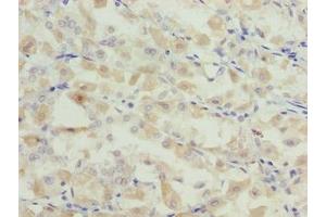 Immunohistochemistry of paraffin-embedded human gastric cancer using ABIN7153839 at dilution of 1:100 (GCSAML Antikörper  (AA 1-135))