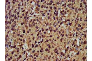 IHC image of ABIN7164940 diluted at 1:400 and staining in paraffin-embedded human glioma performed on a Leica BondTM system. (POMP Antikörper  (AA 1-141))