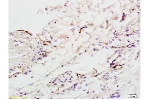 Formalin-fixed and paraffin embedded:human colon carcinoma labeled with Anti-factor VIII(FVIII)(human) Polyclonal Antibody , Unconjugated at 1:200, followed by conjugation to the secondary antibody and DAB staining (Factor VIII Antikörper  (AA 1451-1550))