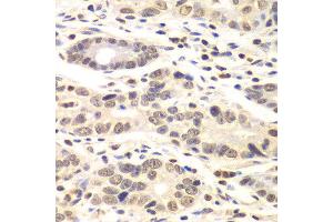 Immunohistochemistry of paraffin-embedded human colon carcinoma using CCNC antibody at dilution of 1:100 (x40 lens). (Cyclin C Antikörper)