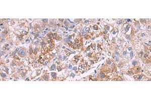 Immunohistochemistry of paraffin-embedded Human liver cancer tissue using GSTCD Polyclonal Antibody at dilution of 1:70(x200) (GSTCD Antikörper)