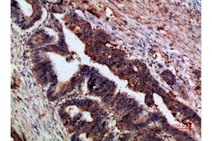 Immunohistochemical analysis of paraffin-embedded human-colon-cancer, antibody was diluted at 1:200 (CTNND1 Antikörper  (AA 841-890))