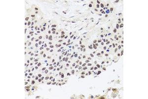 Immunohistochemistry of paraffin-embedded human lung cancer using RPP30 antibody. (RPP30 Antikörper  (AA 1-268))