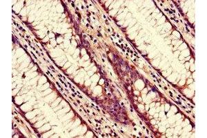 Immunohistochemistry of paraffin-embedded human colon cancer using ABIN7161824 at dilution of 1:100 (NUP85 Antikörper  (AA 201-500))